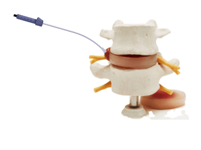 Endoscopia da coluna